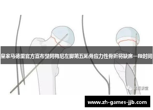 皇家马德里官方宣布楚阿梅尼左脚第五跖骨应力性骨折将缺席一段时间